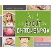 All about Chickenpox